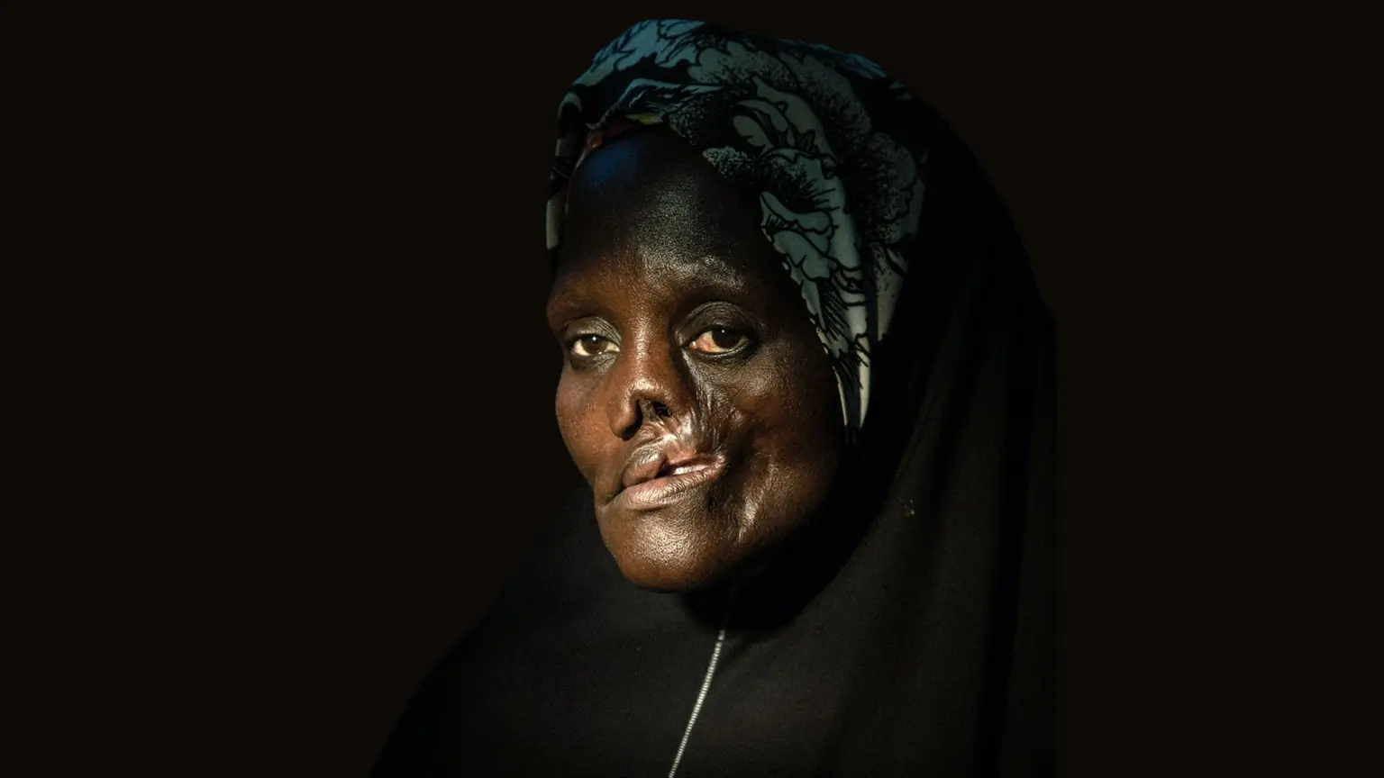40 Noma patients to undergo reconstructive surgery in Sokoto